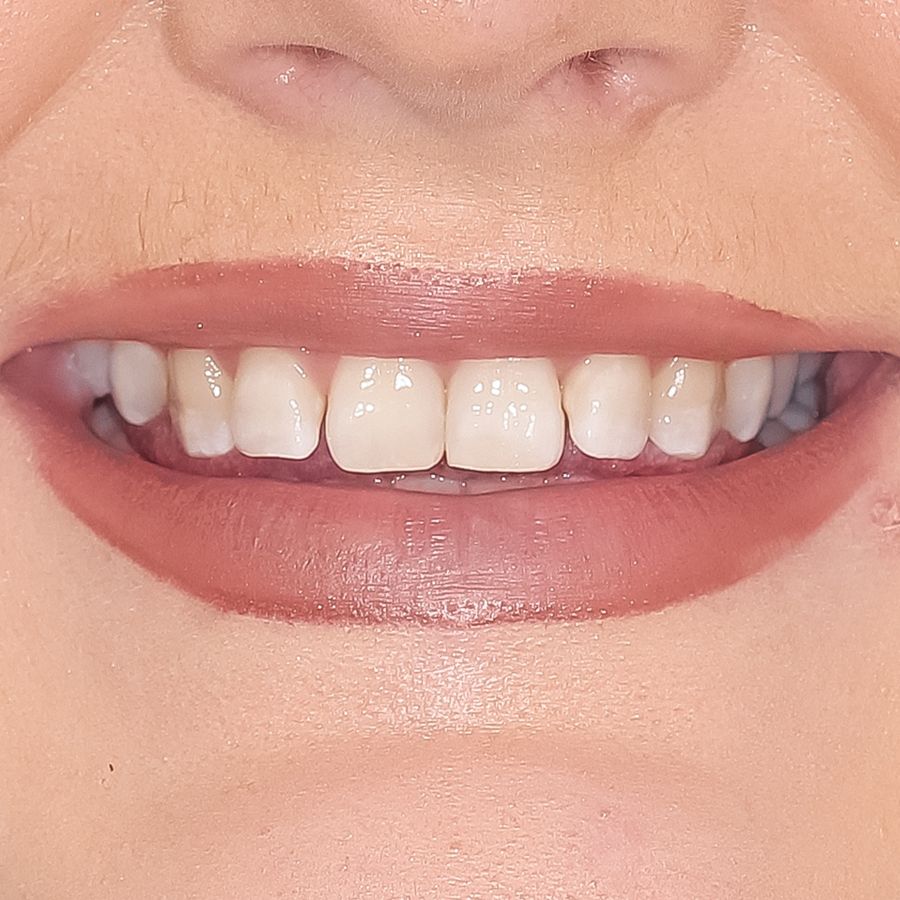 clip on veneers - before - smile 4 - 3Dental